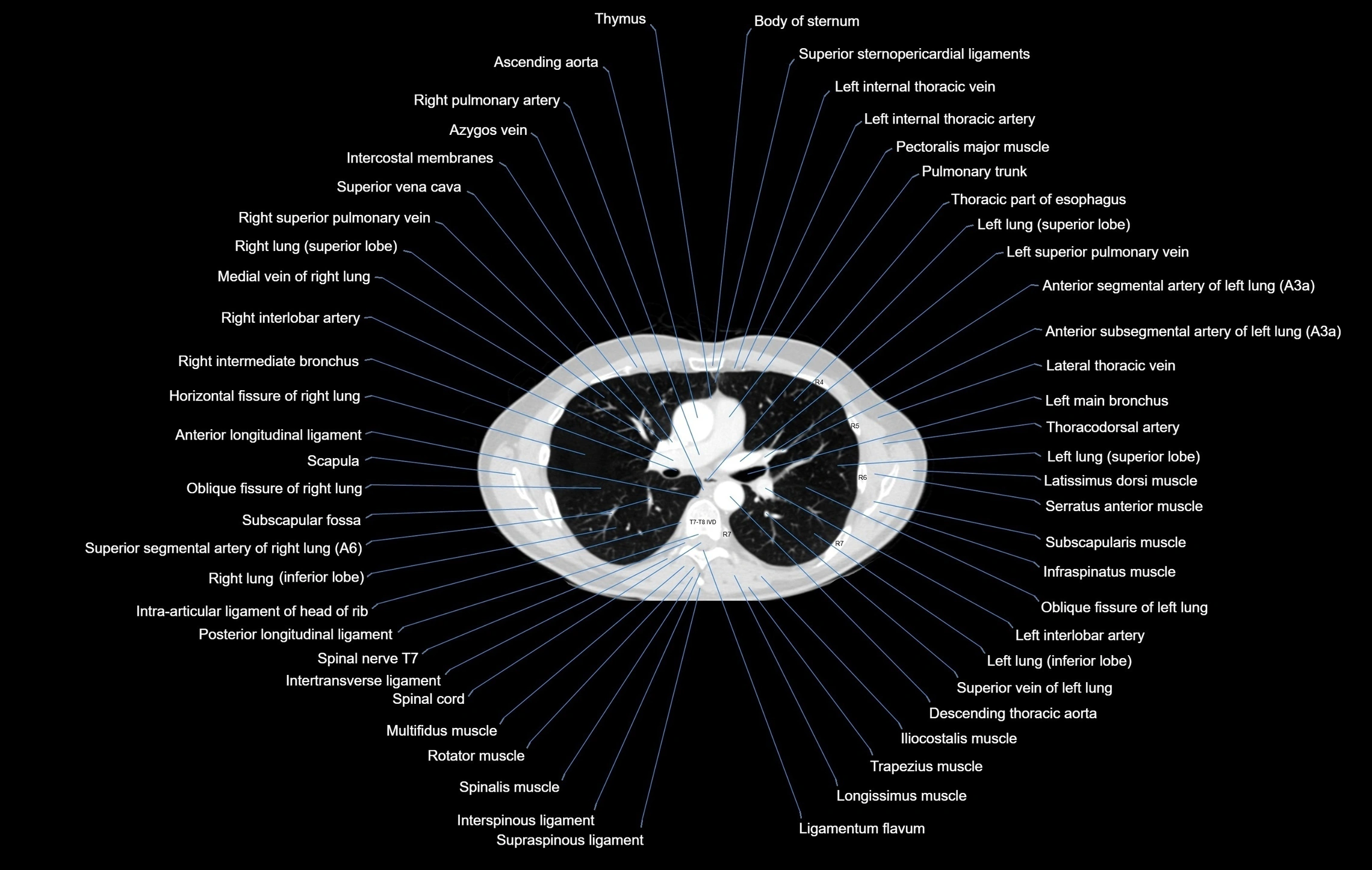 CT chest (thorax) lung window window labelled axial cross sectional anatomy radiology image-00057.webp